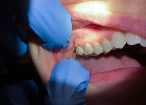 Best Emergency Tooth Extraction in Stonebridge, NJ